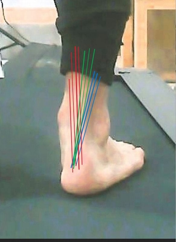 ランニングのアキレス腱炎