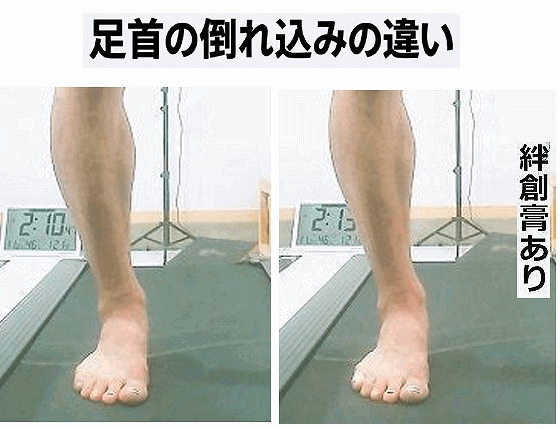小指を絆創膏で固定した前後で、足のアーチの高さと形の変化を比較した画像