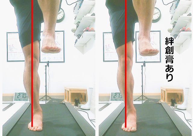 小指の動きを制限した状態で片足立ちを行い、身体が外側へ傾いた様子を示した比較画像
